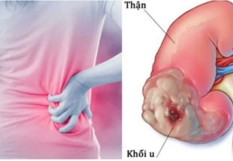 Béo phì và nguy cơ ung thư thận